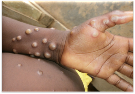Monkey pox (Mpox) Disease